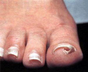 Tratamientos de uñas con hongos enlos pies
