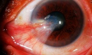 Tratamiento de las enfermedades de la vista a los 40