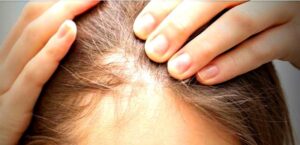 Champú Contra la Alopecia androgenica